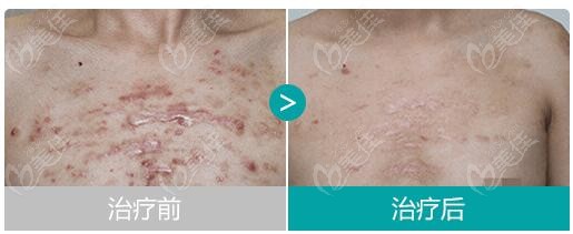 胸背部大面积疤痕疙瘩做非手术综合治疗