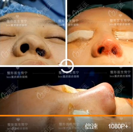 重庆联合丽格唇裂鼻畸形二期修复手术实例图