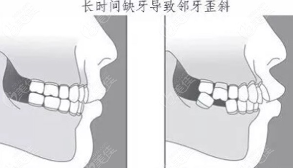 长时间缺牙会导致临牙歪斜