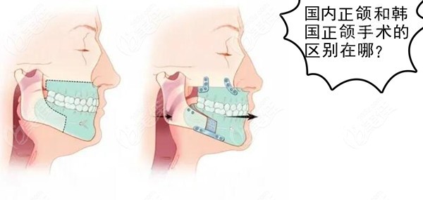 韓國正頜手術為什麼不用術前正畸國內和韓國正頜手術的區別瞭解哈