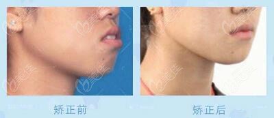 合肥贝杰——戴政医生矫正病例展示