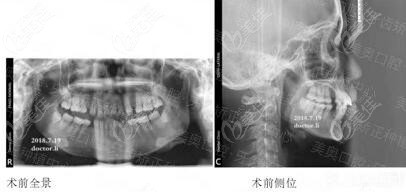 全景片：牙齿稀疏、中线不齐