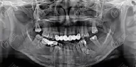 矫治前影像学检查：17、26、36、46缺失，左下前磨牙区34，35根下方有两颗埋伏多生牙
