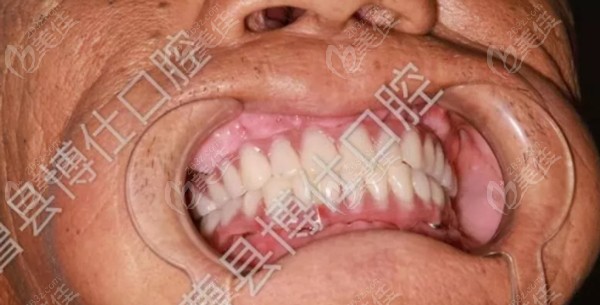 70岁牙龈萎缩还能做满口种植牙吗？分享老人上下各植8颗种植体重获全口好牙实例