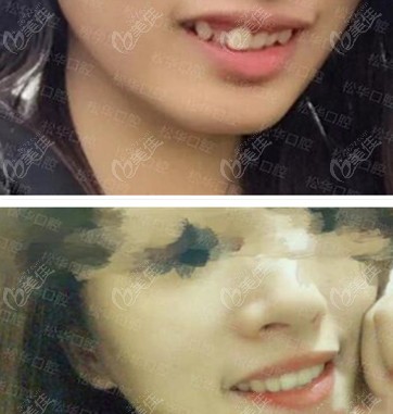 松华口腔：妹妹牙齿不齐矫正前后对比图