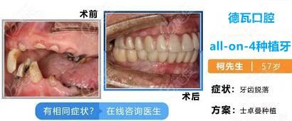 房立増医生完成的all-on-4种植牙病例图