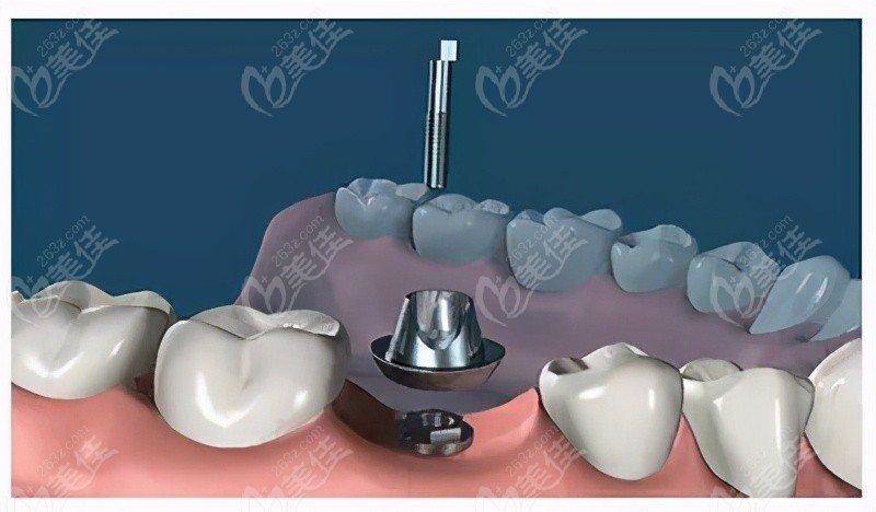 银川艾齿口腔做种植牙的过程步骤二