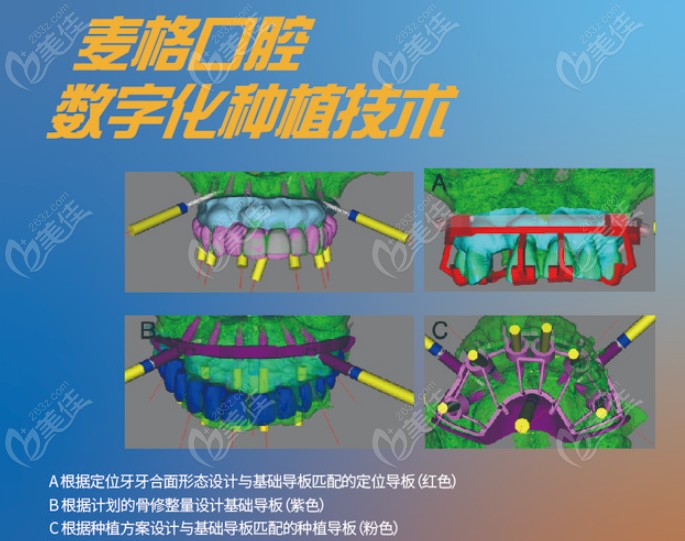 秦皇岛麦格口腔数字化种植牙技术示意图
