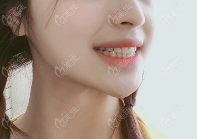 牙齿正常的侧脸图图片