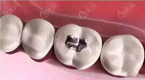 银汞合金补牙方式