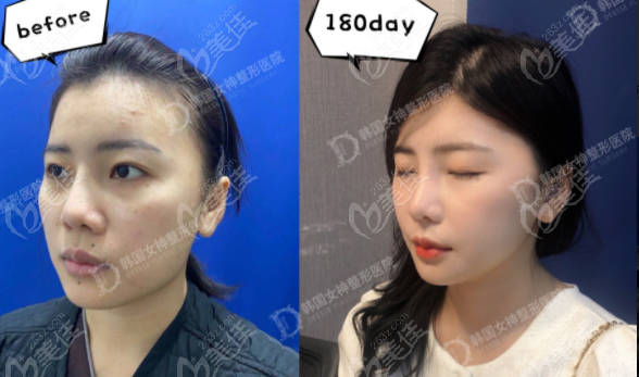 韩国女神整形医院下颌角手术实例图