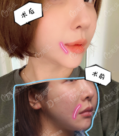 韩国女神整形做的嘴角上扬手术和M唇实例效果图，花费3万左右