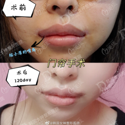 韩国女神上唇门帘手术6个月对比图片