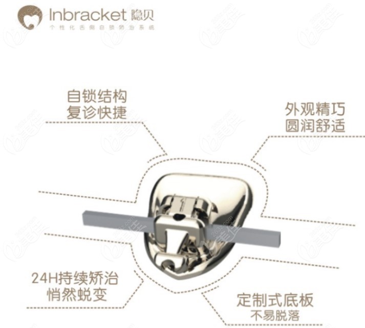 Inbracket隐贝舌侧矫正器优点