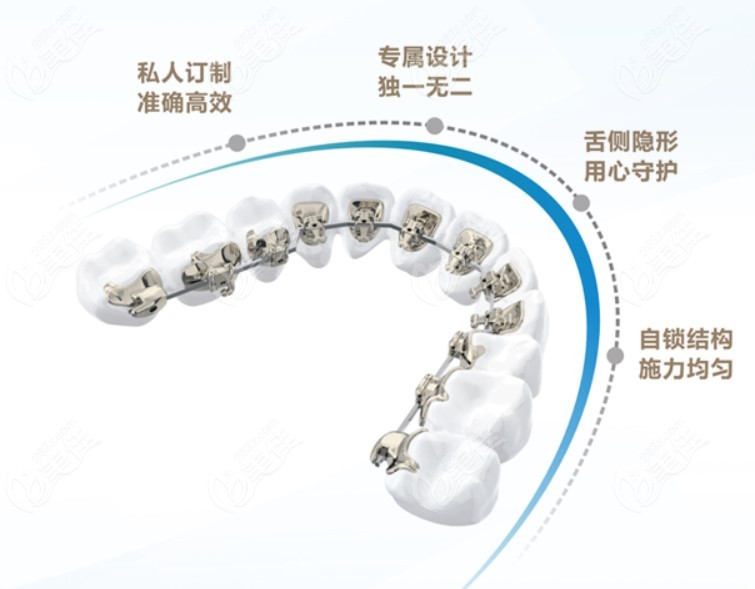 Inbracket隐贝舌侧矫正器