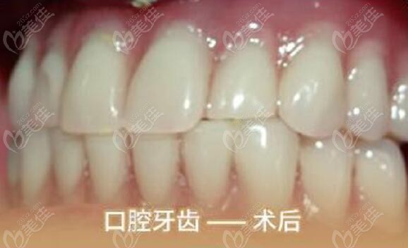 allon4全口种植牙整个过程/流程只用了2小时