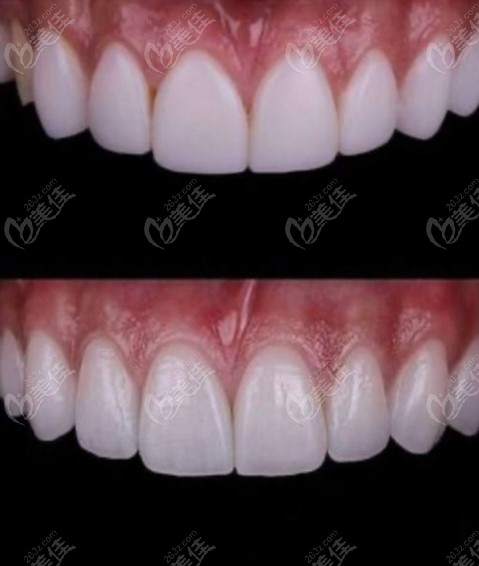 维乐口腔美学贴面