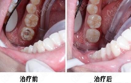 补牙使用瓷睿刻全瓷牙治疗前后对比图
