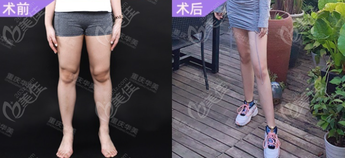 重庆潘宝华医生打瘦肩针和瘦腿针的实例效果图，花费3万左右