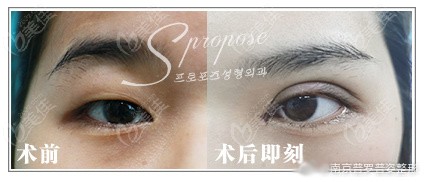 连欧式宽双眼皮都能修复自然的扇形，你说南京原韩做的双眼皮怎么样