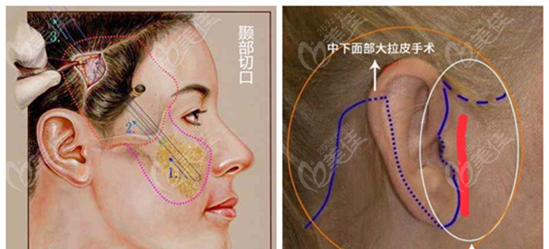 面部皮纹切口选择图图片