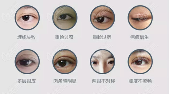 需要做双眼皮修复的情况