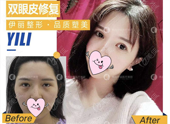 伊丽整形医院黄蕾做的双眼皮修复对比图