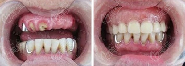 半口种植牙修复对比