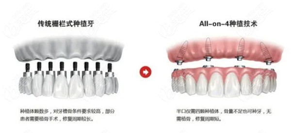 ALL- on-4种植牙技术与传统种植牙区别