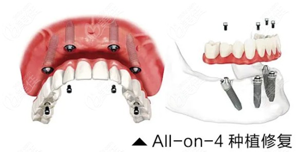 all-on-4种植牙修复技术优势
