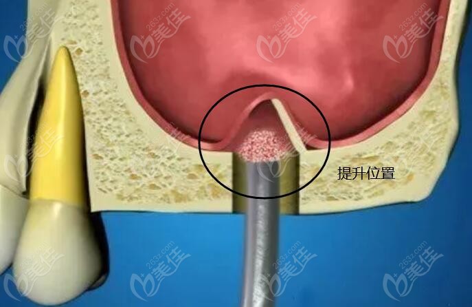 上颌窦内提升术过程图片