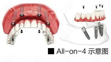 all-on-4种植牙示意图