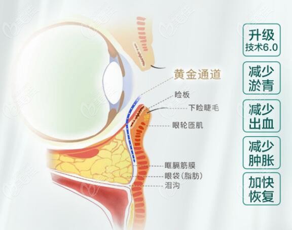 <i data-id='69f60ac4-ff71-461c-9d9d-191f00e9cbef' style='display:none;'></i>不开刀去眼袋技术 <i data-id='69f60ac4-ff71-461c-9d9d-191f00e9cbef' style='display:none;'></i>不开刀去眼袋技术