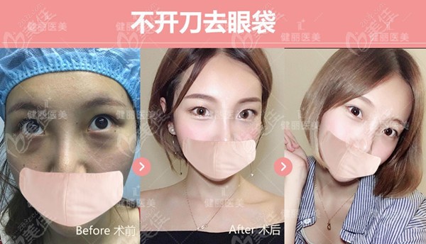 <i data-id='69f60ac4-ff71-461c-9d9d-191f00e9cbef' style='display:none;'></i>不开刀去眼袋对比图 <i data-id='69f60ac4-ff71-461c-9d9d-191f00e9cbef' style='display:none;'></i>不开刀去眼袋对比图