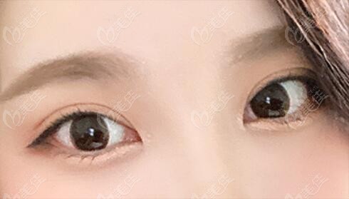 韩国icon整形外科三重埋线双眼皮修复术30天恢复照