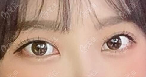 韩国icon整形外科真人三重埋线双眼皮修复术后60天照