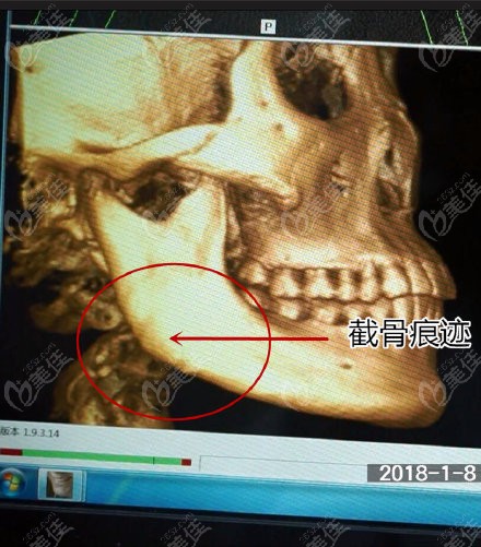 下颌骨拐角凸起一块图片