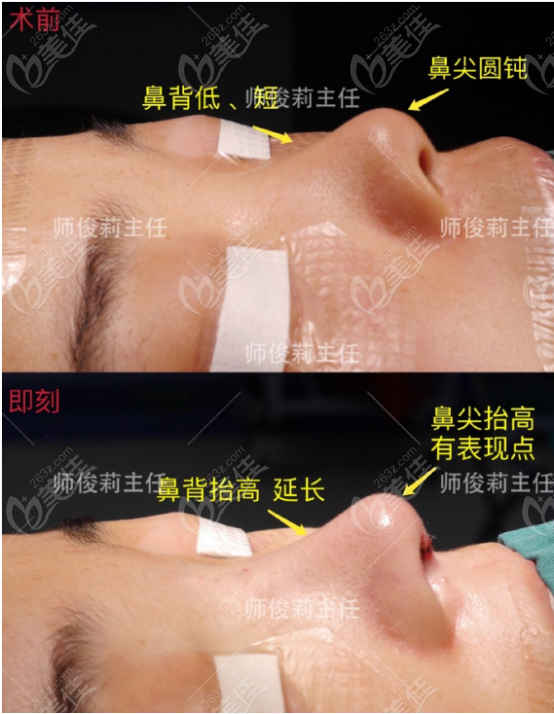 西安做缩鼻翼缩鼻头手术好的医院做出来的真人实例图