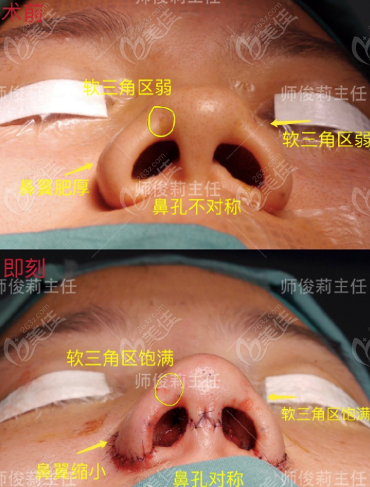西安做缩鼻翼缩鼻头手术好的医院做出来的真人实例图