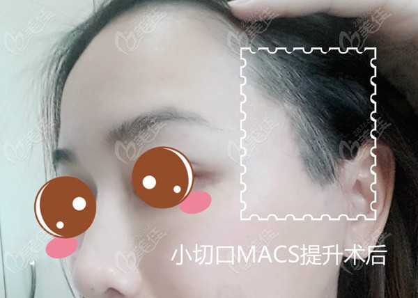 30多岁做小切口macs提升术后恢复疤痕也不明显