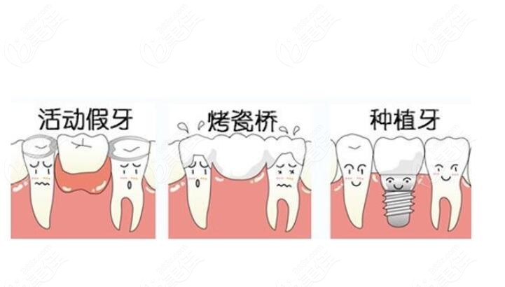 三种镶牙方式