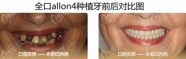 这是70岁老人在北京京立口腔做allon4即刻负重满口种植牙的图片