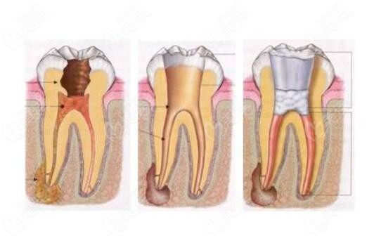 牙体牙髓病的发生