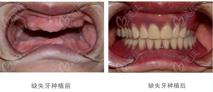 精卓口腔种植医生李峥为顾客做全口种植牙前后对比图