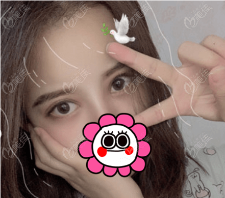 株洲华美做眼综合怎么样？我的术后样子参考