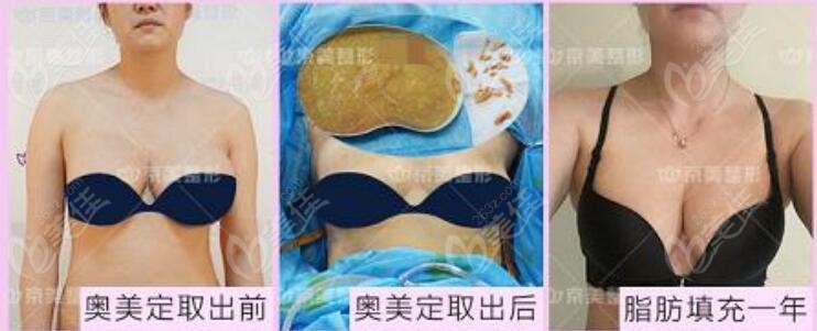 京美<!--<i data=20240703-sp></i>-->取奧美定同時做自體脂肪隆胸對比照
