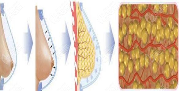 北京<!--<i data=20240703-sp></i>-->脂肪隆胸技術(shù)優(yōu)勢