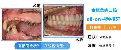 美奥汪龙河医生的all-on-4种植病例图