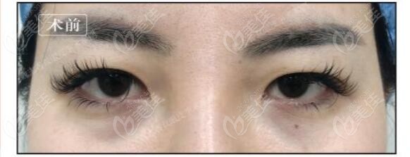 北京魏志香双眼皮修复真人实例：术前照片