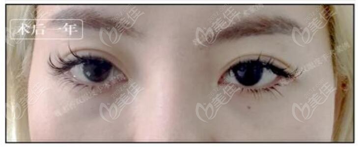 北京魏志香双眼皮修复真人实例：术后一年恢复照片